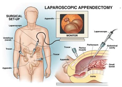 Laparoscopic Appendix Removal (Appendectomy) Surgery Patient Information