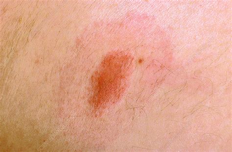 Bullseye Rash - Stock Image - C022/1881 - Science Photo Library