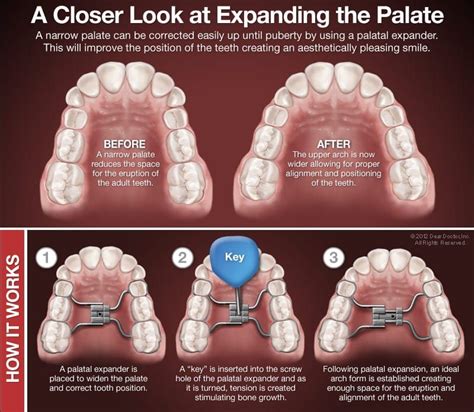 Palatal Expander