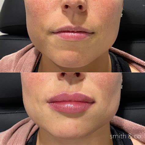 kysse + ashton — Miami Beach Botox Specialist | Botox lips, Lips inspiration, Lip fillers