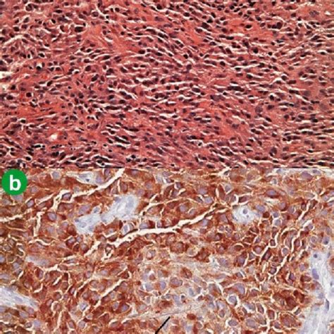 Pathology slides confirming the final diagnosis of malignant melanoma... | Download Scientific ...