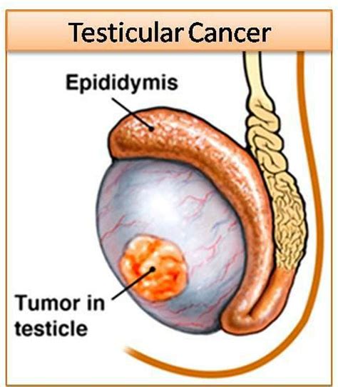 Urologists advocate screening for testicular cancer, BPH