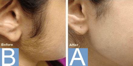 Laser Hair Removal Treatment Explained For All Skin Types - West London