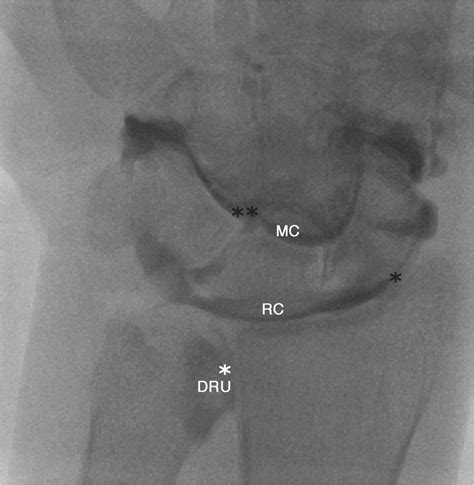 Conventional arthrogram showing three normal compartments of the wrist ...