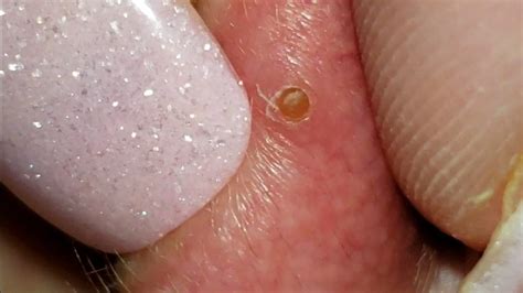 Pimple Popping Videos 2024 Blackheads Removal Youtube - Lina Shelby