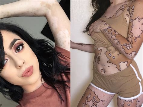 How Instagram Helped One Woman Fall In Love With Her Vitiligo | SELF