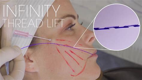 Infinity Thread Lift with Chin and Jawline Filler: Combination Therapies by Dr. Kian Karimi ...