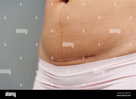 Hysterectomy scar hi-res stock photography and images - Alamy