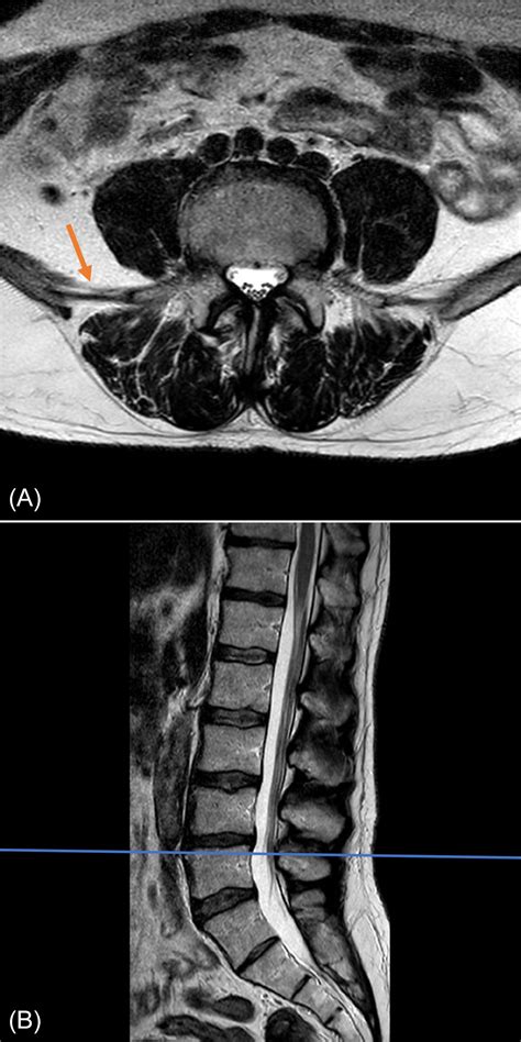 Lumbosacral Spine MRI | Radiology Key