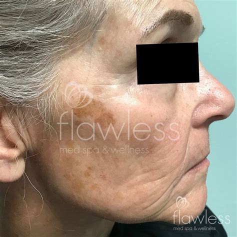 Patient 58193336 | Age Spots Before & After Photos | Flawless Medspa