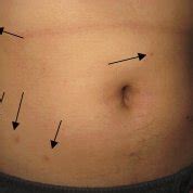 Bite marks (arrows) caused by cat fleas in one of the infested students. | Download Scientific ...