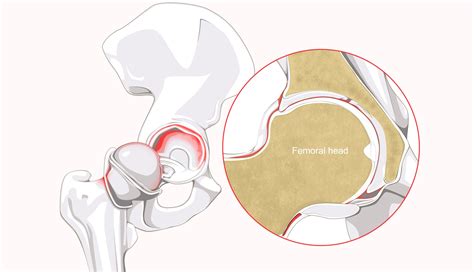 Labral Tears and a Track Athlete - Surgery on Kids - Regenexx