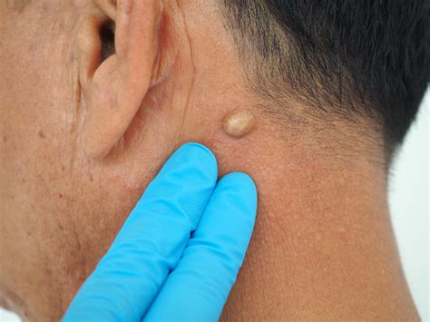 What is a Sebaceous cyst? - Diamond Skin Care