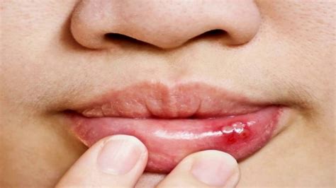 Cold Sore Inside Lip Pictures - PictureMeta