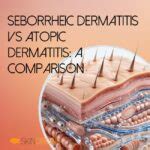 Seborrheic Dermatitis vs Atopic Dermatitis: A Comparison – SkinDrone
