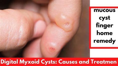 Mucous cyst finger home remedy | Digital Myxoid Cysts: Causes and Treatment - YouTube