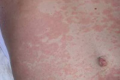 Differential Diagnosis: Maculopapular Rash Differential Diagnosis