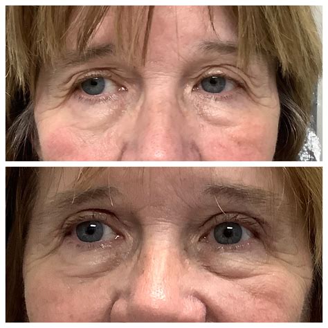 Blepharoplasty Before and After - Joseph Eye and Laser