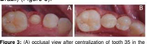 Figure 3 from Microdontia treatment with orthodontics and indirect restoration: clinical case ...