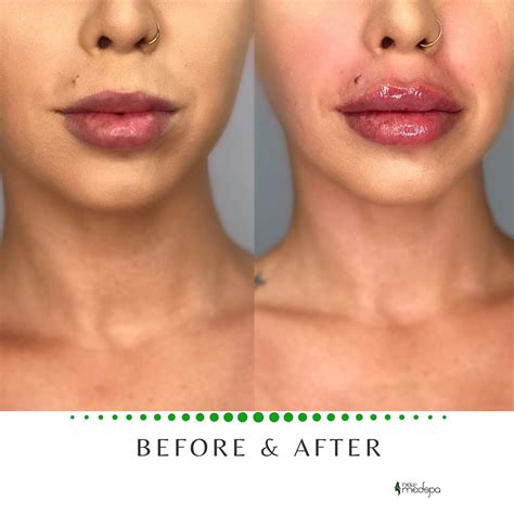 Lip Filler Before and After | Lip fillers cost, Lip fillers, Aesthetic dermatology