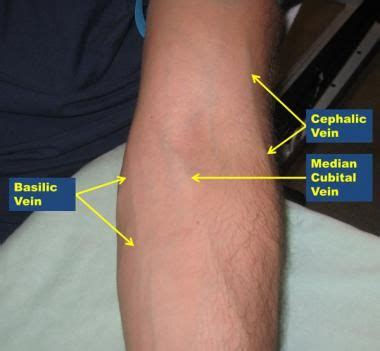 Remember your median cubital for those lithium levels