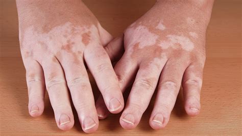 Hammerling: Got white spots on your skin? It could be vitiligo