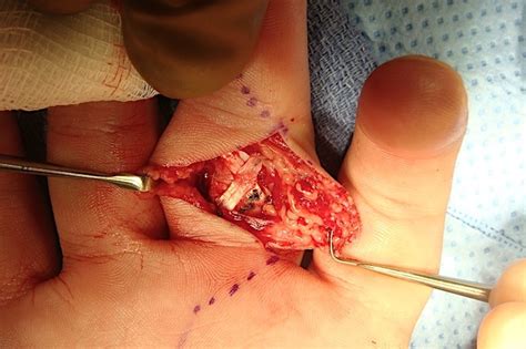 A-2 PULLEY RUPTURE (FLEXOR TENDON SHEATH RUPTURE) | Hand Surgery Resource