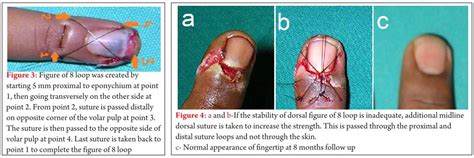 Finger tip injury; nail bed laceration; partial nail plate avulsion; complete nail plate ...
