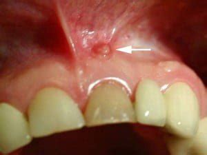 ¿Qué es una fístula dental? - Dental ASCH