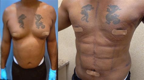 Gynecomastia Surgery: 48 Hour Post Op Results - YouTube