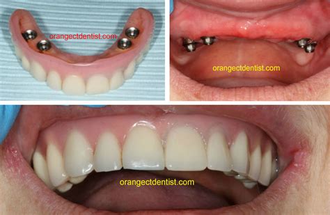 Implant Supported Dentures | Dentist Orange, Woodbridge, New Haven CT