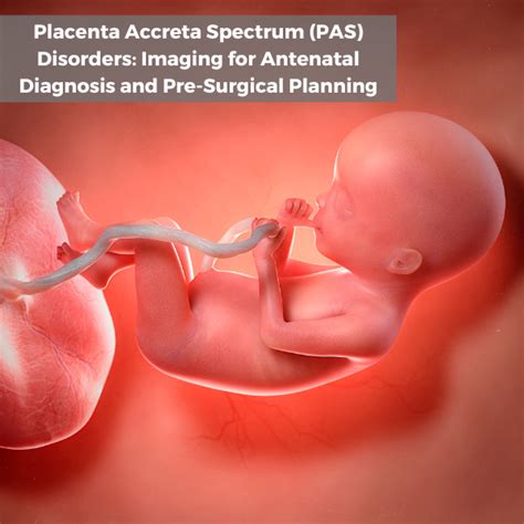 Event- Placenta Accreta Spectrum Disorders