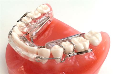 Inman Aligner Cost – A Guide To The Inman Aligner