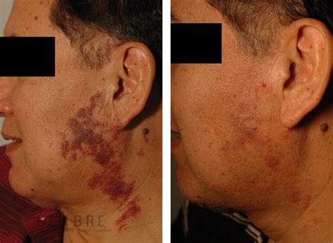 Discomfort or bleeding from vascular birthmarks (occasional) - Pictures