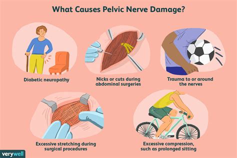 What Causes Pelvic Nerve Pain?