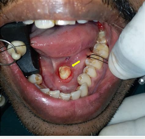 Figure 1 from Sialolithiasis of the Submandibular Gland: Report of Cases | Semantic Scholar