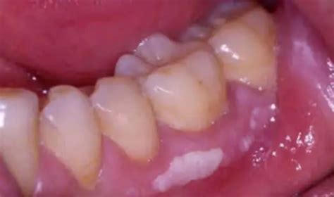 White Spots on Gums, on Baby, Painful Small White Bumps, Patches, Dots above Tooth Treatment