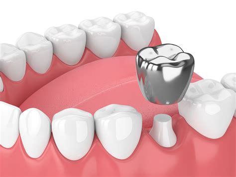 What Is The Process Of Having A Cap Or Crown Placed On Your Teeth ...