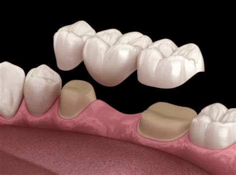 Types of Dental Bridges - Dentist in Cohoes, NY