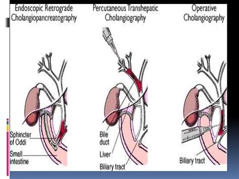 Biliary stricture ppt