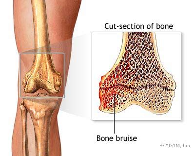 Bone Bruise | New Health Guide