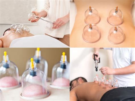 Cupping Therapy: Know Procedure, Benefits, Side- Effects - TV Health