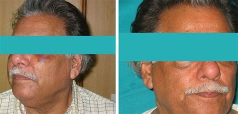 Best Cosmetic Surgeon in Hyderabad - Dr Y V Rao clinic
