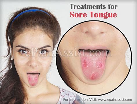 Treatments for Sore Tongue | Tongue sores, Tongue sores causes, Soreness