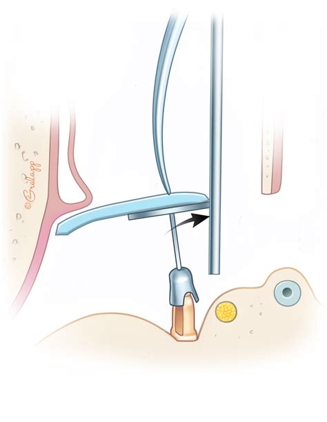 Ossiculoplasty – Oto Surgery Atlas