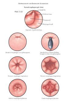 CAMERON LESIONS AND DISORDERS OF THE CARDIA | Nuclear imaging ...