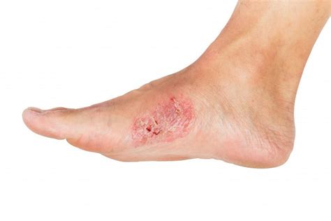 How to Tell if Your Blister Is Infected: Neuhaus Foot & Ankle: Podiatry