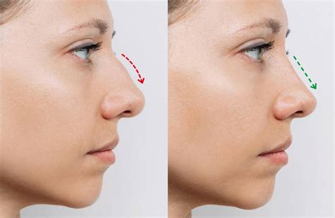 Rhinoplasty Recovery Guide: Pain Management & Long-Term Care