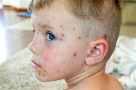 Chickenpox: Causes, Symptoms, Treatment Prevention, 49% OFF