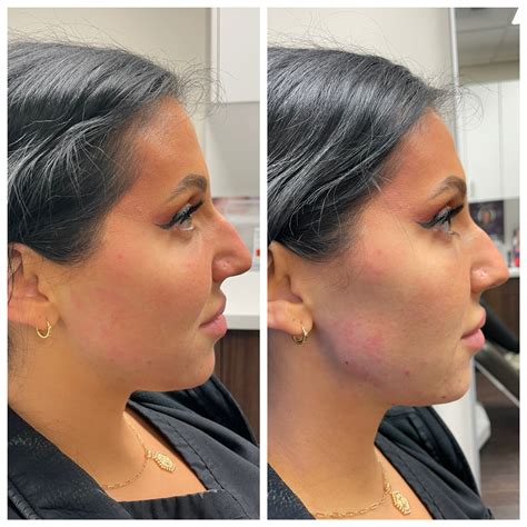 Patient 146804124 | Jawline Augmentation Gallery Before & After Photos ...